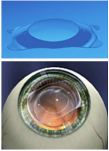 لنزهای ایمپلنت (لنزهای داخل چشمی IOL)