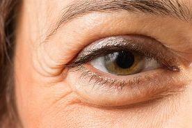 puffy-eye-1200x630-1-e1538452695185_993ac260741919a68094971d0fcbecdc