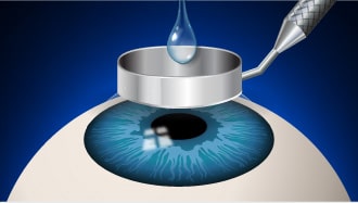 ثابت کردن پلک ها برای انجام عمل لازک چشم