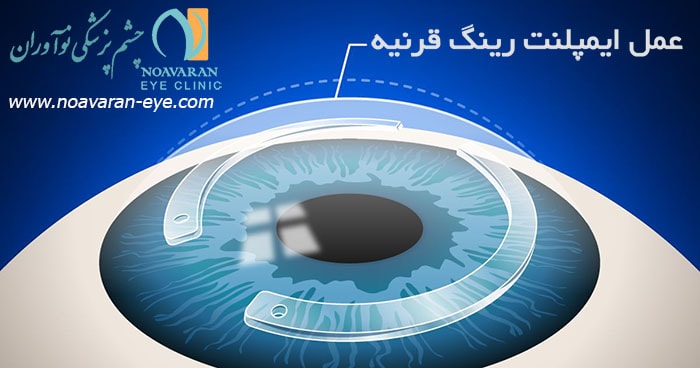 عمل ایمپلنت رینگ قرنیه توسط رینگهای داخل چشمی برای درمان قوز قرنیه  