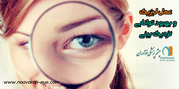 عمل لیزیک و بهبودی توانایی نزدیک بینی