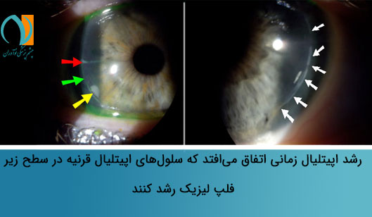رشد اپیتلیال قرنیه بعد از عمل لیزیک چشم